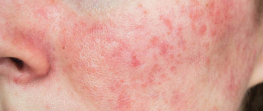 Tutto quello che devi sapere sulla rosacea